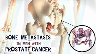 Development Of BONE METASTASIS In Men With PROSTATE CANCER  osteology [upl. by Ardnola]