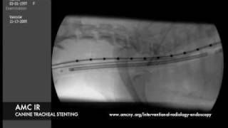 Interventional Radiology Tracheal Stent [upl. by Amiarom]