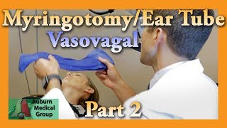 Myringotomy amp Ear Tube Part 2 Vasovagal Feat Dr Tim Fife  Auburn Medical Group [upl. by Bashemeth]