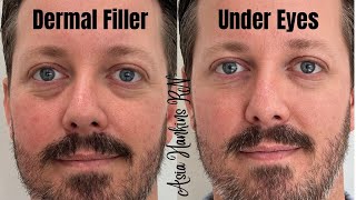 How to get rid of under eye hollows darkness Under eye restoration with dermal fillers [upl. by Eisse797]