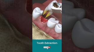 Tooth Extraction Procedure ↪ 3D Medical Animation Shorts Tooth ToothExtraction [upl. by Roosevelt]