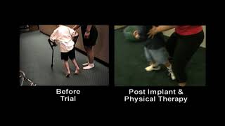 Dr Georgios Matis  Neuromodulation  Cerebral palsy before amp after intrathecal baclofen therapy [upl. by Grover491]