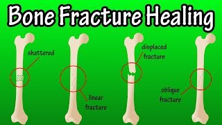 How Does A Bone Break Heal  Bone Fracture Healing Process [upl. by Julieta817]