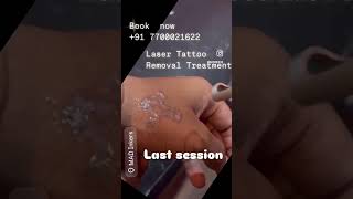 madinkers lasertattooremovalspecialist tattooremoval tattooremovalspecialist tattoo [upl. by Sunda]