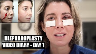 Blepharoplasty Video Diary  Day 1 After Surgery 1 of 15 [upl. by Ollie]