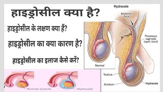 What is Hydrocele  Symptoms causes amp Treatment  हाइड्रोसील क्या है और उसका इलाज कैसे किया जाता है [upl. by Naitsyrk]