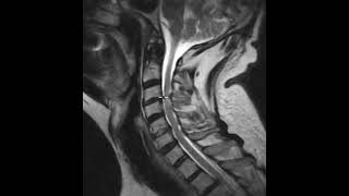 Cervical canal stenosis and spinal cord atrophy [upl. by Franciska354]