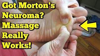 Mortons Neuroma Massage  Exercises to AVOID Surgery [upl. by Arymahs962]