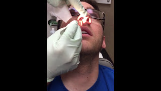 Deviated Septum Splint Removal [upl. by Erreip357]