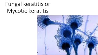 Fungal keratitis causes clinical sign and management [upl. by Lunt]