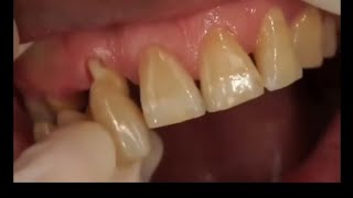 Best teeth cap 🔥Cost before and after live in patientzirconiacap [upl. by Licko]