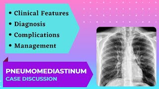 Case Presentation  Acute Chest Pain  Pneumomediastinum [upl. by Monney]