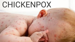 CHICKENPOX  Chickenpox Virus [upl. by Ahsiled]