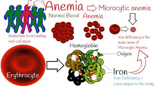 Iron deficiency anemia  Most Common anemia Microcytic anemia symptoms and treatment [upl. by Aeht388]