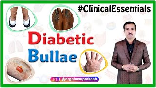 Diabetic bullae Bullosis Diabeticorum  Clinical essentials [upl. by Auqinal]