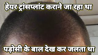 hair transplant krane ja raha tha  alopecia  hair transplant result  hair fall solution [upl. by Yrrol]