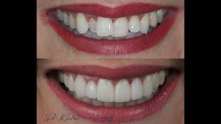 How to fix crooked teeth Smile Makeover Australia vol 13 with Dr Richard Crowns Veneers Hollywood [upl. by Nomolas78]