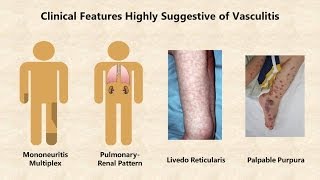 Vasculitis  An Overview [upl. by Annette]