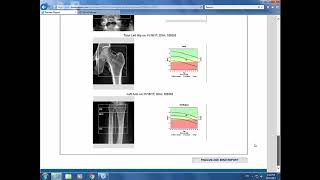 Webinar Bone Densitometry Reporting in High Volume Practices [upl. by Henke]