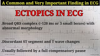 ECG Ectopics Explained  Learn about Ectopics APCs amp VPCs  Ventricular Trigeminy ECG [upl. by Nannek]