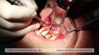 La Chirurgie Endodontique  Dr Matthieu Marret [upl. by Ransell]