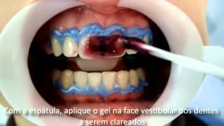 Whiteness HP Maxx  FGM l Dental Speed [upl. by Roxanne]