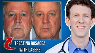 ROSACEA  DERMATOLOGIST DEEP DIVE [upl. by Wernick506]