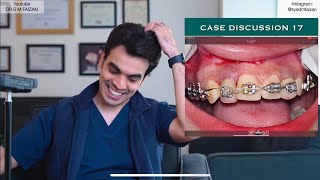 Orthobraces treatment Disaster  Case 17 [upl. by Yelahs]