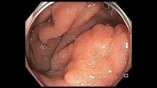 Colonoscopy Cecum Flat Lesion  EMR  Technically Challenging Area [upl. by Nelra]