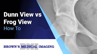 How to  Dunn View vs Frog View [upl. by Akiaki561]