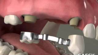 Dentures Precision Partial Procedure [upl. by Tips]