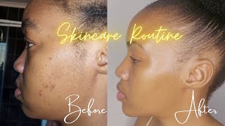 My skincare routine for acne  Under R50  South African YouTuber [upl. by Attenauqa]