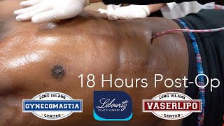 GYNECOMASTIA SURGERY 18 Hrs PostOp ‼️VASER 4D HIDEF LIPO Gland Removal amp JPLASMA  Dr Lebowitz [upl. by Ayekal144]