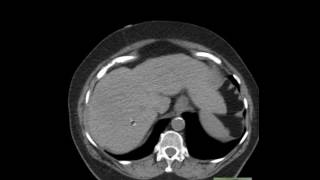 CT Abdomen Epiploic Appendagitis and anatomy [upl. by Amund]