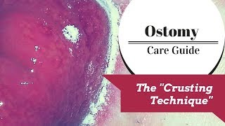 The Ostomy Crusting Technique Explained [upl. by Ariew]