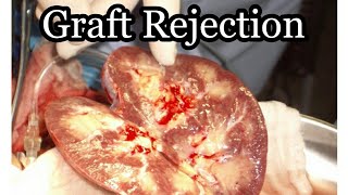 Graft Rejection  MisMedicine [upl. by Rexana]