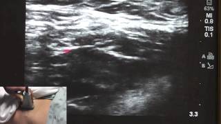 Ultrasound Guided Fascia Illiaca  SSRAUSAcom [upl. by Sileas]