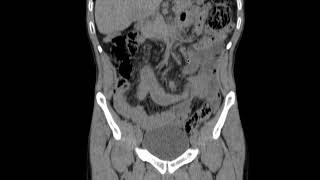 Ileoileal intussusception due to ileal lipoma and resultant mesenteric volvulus [upl. by Lilac]