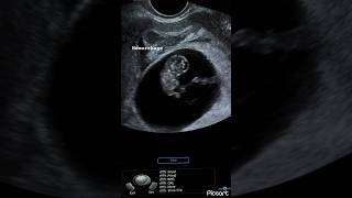 8 weeks fetus subchorionic hemorrhage peri sac hematoma ultrasound ardms sonography radiology [upl. by Martijn]