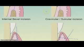 How to put internal bevel incision [upl. by Aniham]