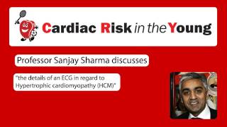 ECG 2 Hypertrophic cardiomyopathy HCM [upl. by Zzahc]