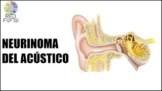 Neurinoma del Acústico Schwanomma Vestibular [upl. by Eylk]