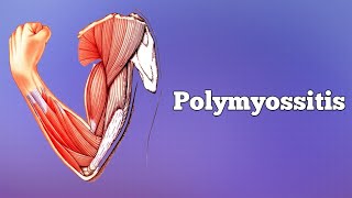 Polymyositis amp Dermatomyositis [upl. by Julis]