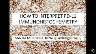 How to interpret a PDL1 immunostain [upl. by Eob87]