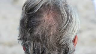 Plucking gray hair tends to result in more some cases are reversible Japan expert [upl. by Vasya857]