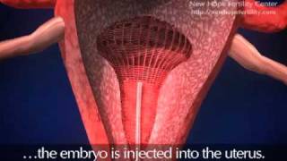 Embryo Transfer [upl. by Liba]