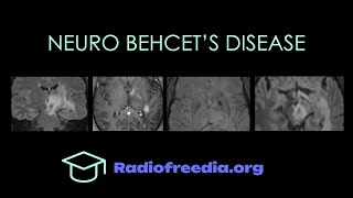 Neuro Behcets Disease Imaging Walkthrough  Radiofreediaorg [upl. by Nadler465]