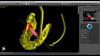 BSP49  Step by Step Implant Planning Wizard [upl. by Dusa]