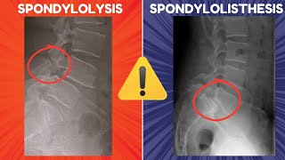 Spondylolysis vs Spondylolisthesis  Definitions Diagrams and Radiographic Appearances [upl. by Arannahs381]