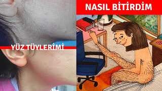 Yüz Tüylerimden İğneli Epilasyonla Nasıl Kurtuldum [upl. by Aytak]